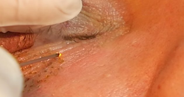 Plasma Skin treatment