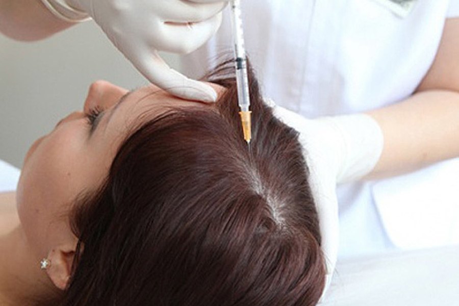 Needle mesotherapy scalp treatment