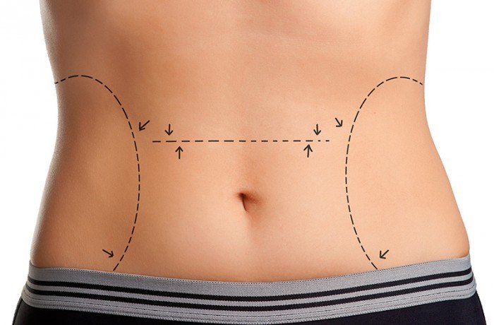 Injection lipolysis body treatment
