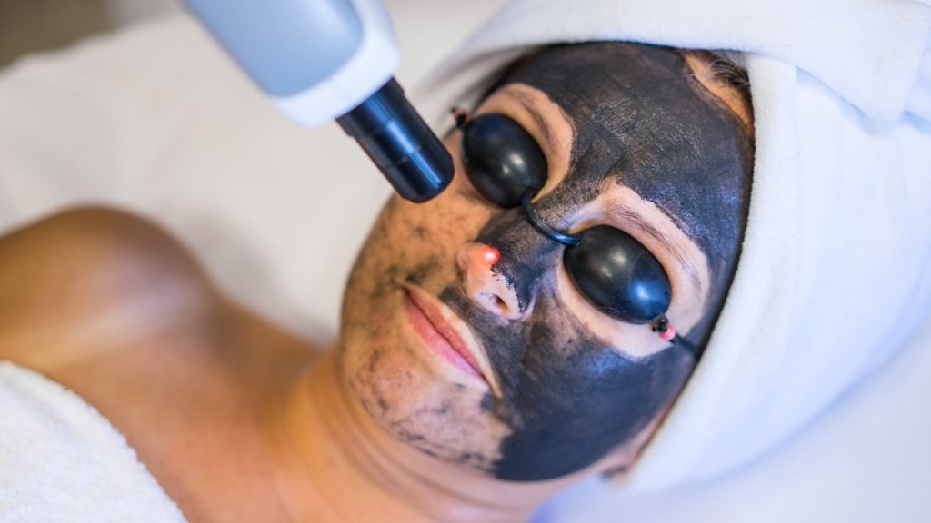 Laser carbon peel treatment
