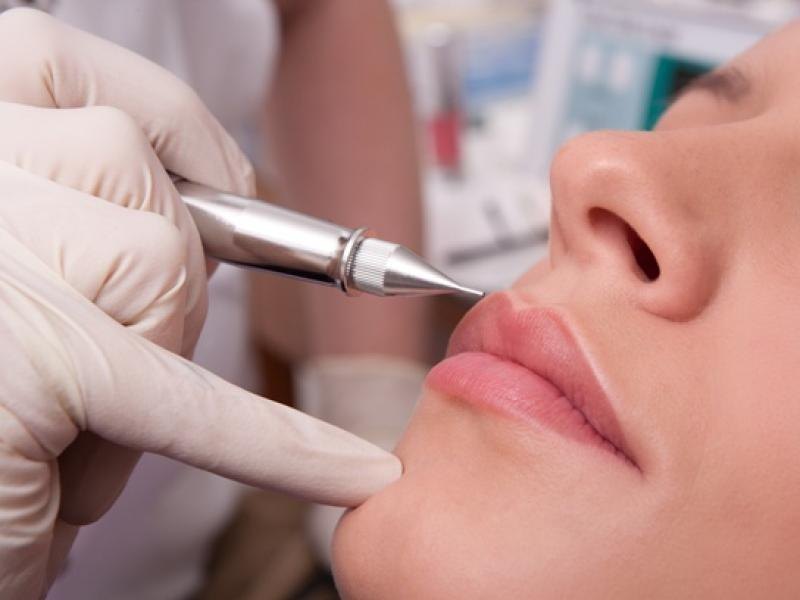 Laser removal of tattoo and permanent makeup