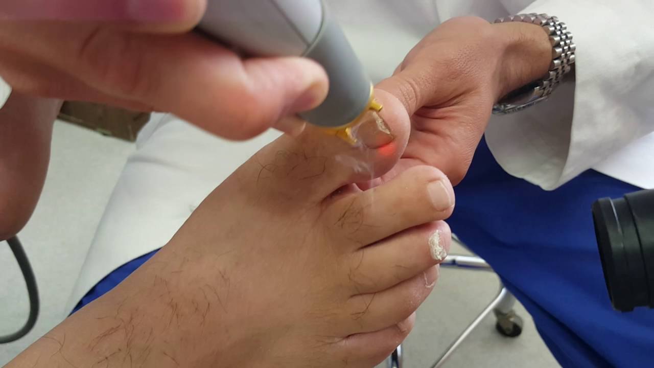 Laser treatment for fungal nails