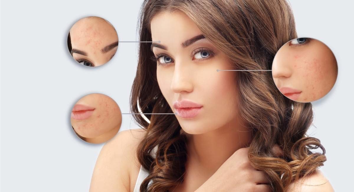 Laser acne treatment