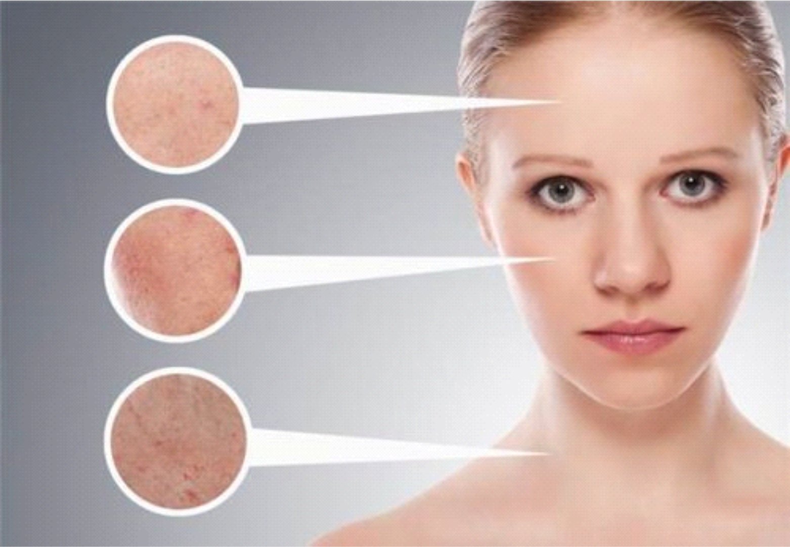Laser treatment for visible vessels and thread veins
